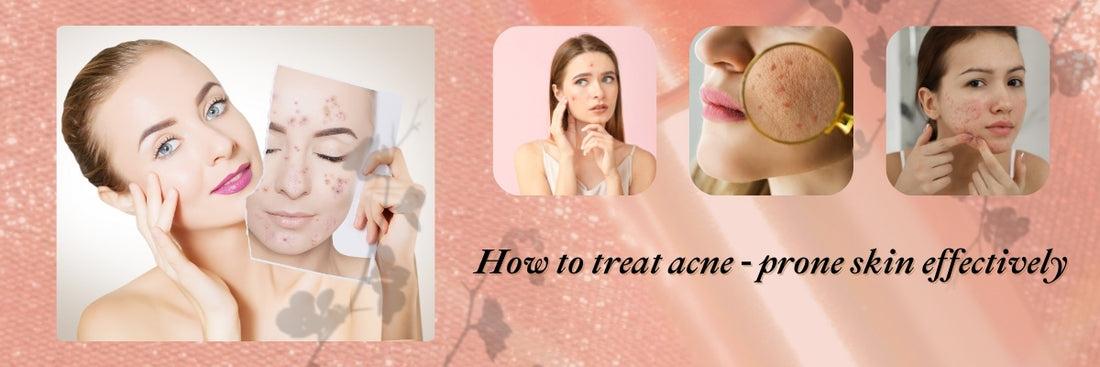 How to Treat Acne-Prone Skin Effectively